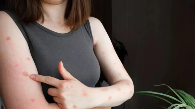 Νέο Πρωτόκολλο Εμβολιασμού κατά του Ιού Mpox στην Ελλάδα: Όσα Πρέπει να Γνωρίζετε